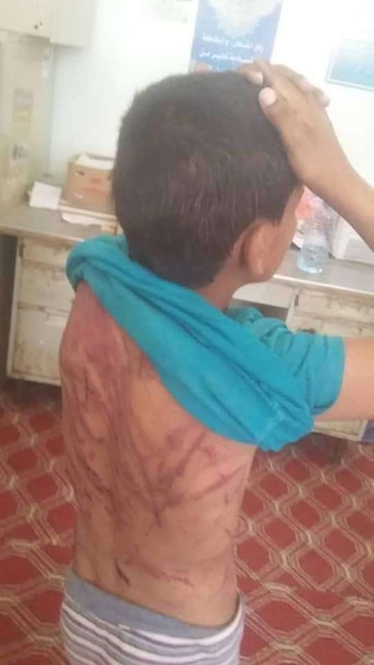 تعرض طفل للضرب المبرح من قبل والده بالمحويت(صور)